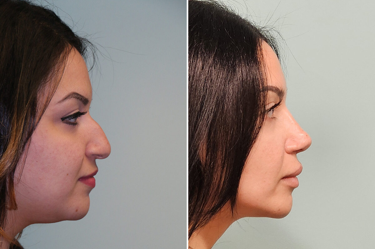Before and after Rhinoplasty by Dr. Shervin Naderi, Patient 51129
