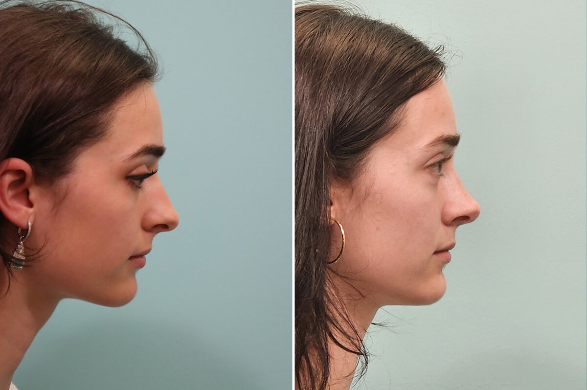 Before and after Rhinoplasty by Dr. Shervin Naderi, Patient 51605