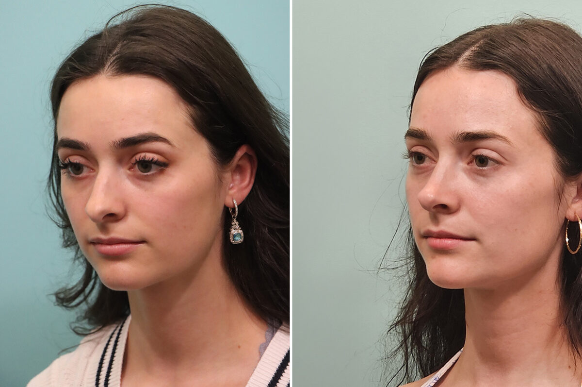 Before and after Rhinoplasty by Dr. Shervin Naderi, Patient 51605