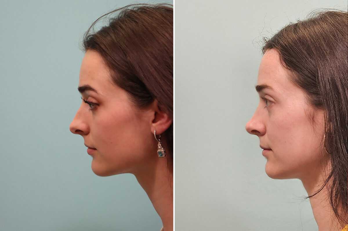 Before and after Rhinoplasty by Dr. Shervin Naderi, Patient 51605