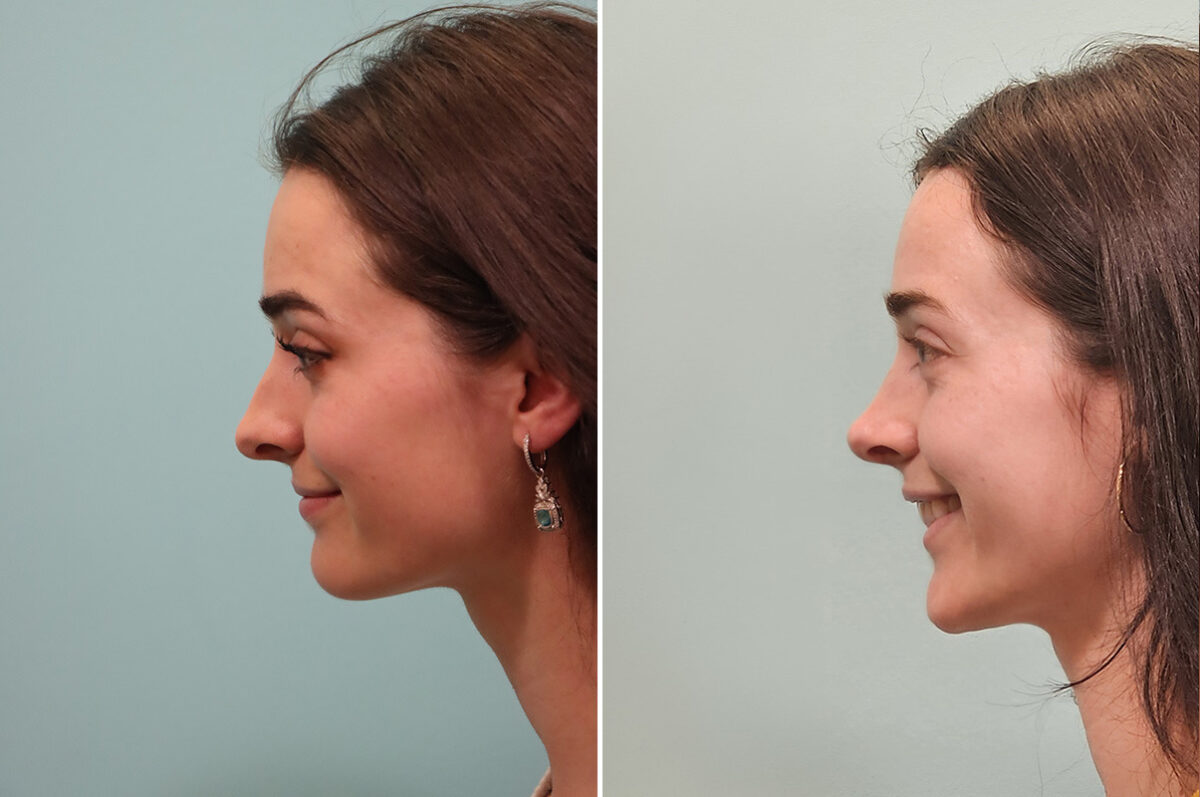 Before and after Rhinoplasty by Dr. Shervin Naderi, Patient 51605