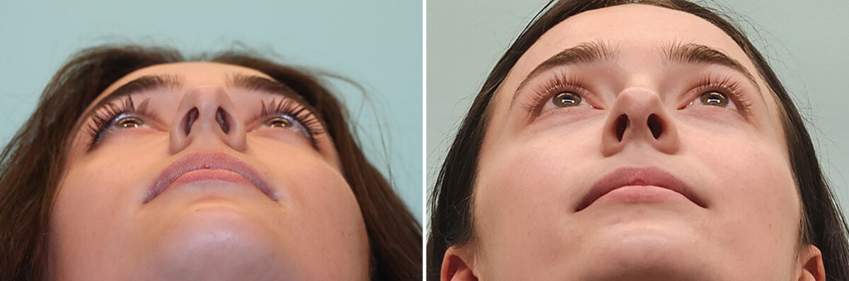 Before and after Rhinoplasty by Dr. Shervin Naderi, Patient 51605