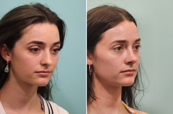Before and after Rhinoplasty by Dr. Shervin Naderi, Patient 51605