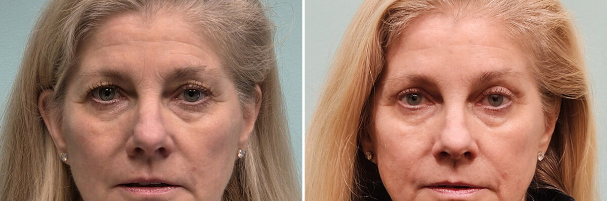 Before and after Blepharoplasty by Dr. Shervin Naderi, Patient 51629
