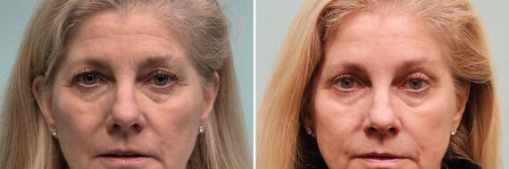 Before and after Blepharoplasty by Dr. Shervin Naderi, Patient 51629