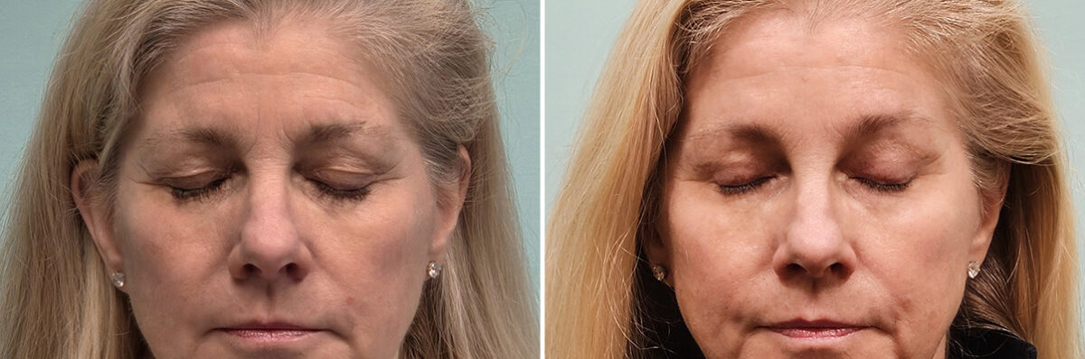 Before and after Blepharoplasty by Dr. Shervin Naderi, Patient 51629
