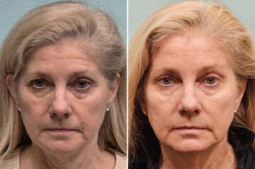 Before and after Blepharoplasty by Dr. Shervin Naderi, Patient 51629