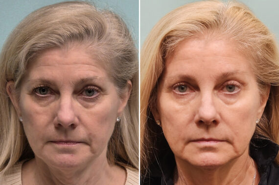 Before and after Blepharoplasty by Dr. Shervin Naderi, Patient 51629