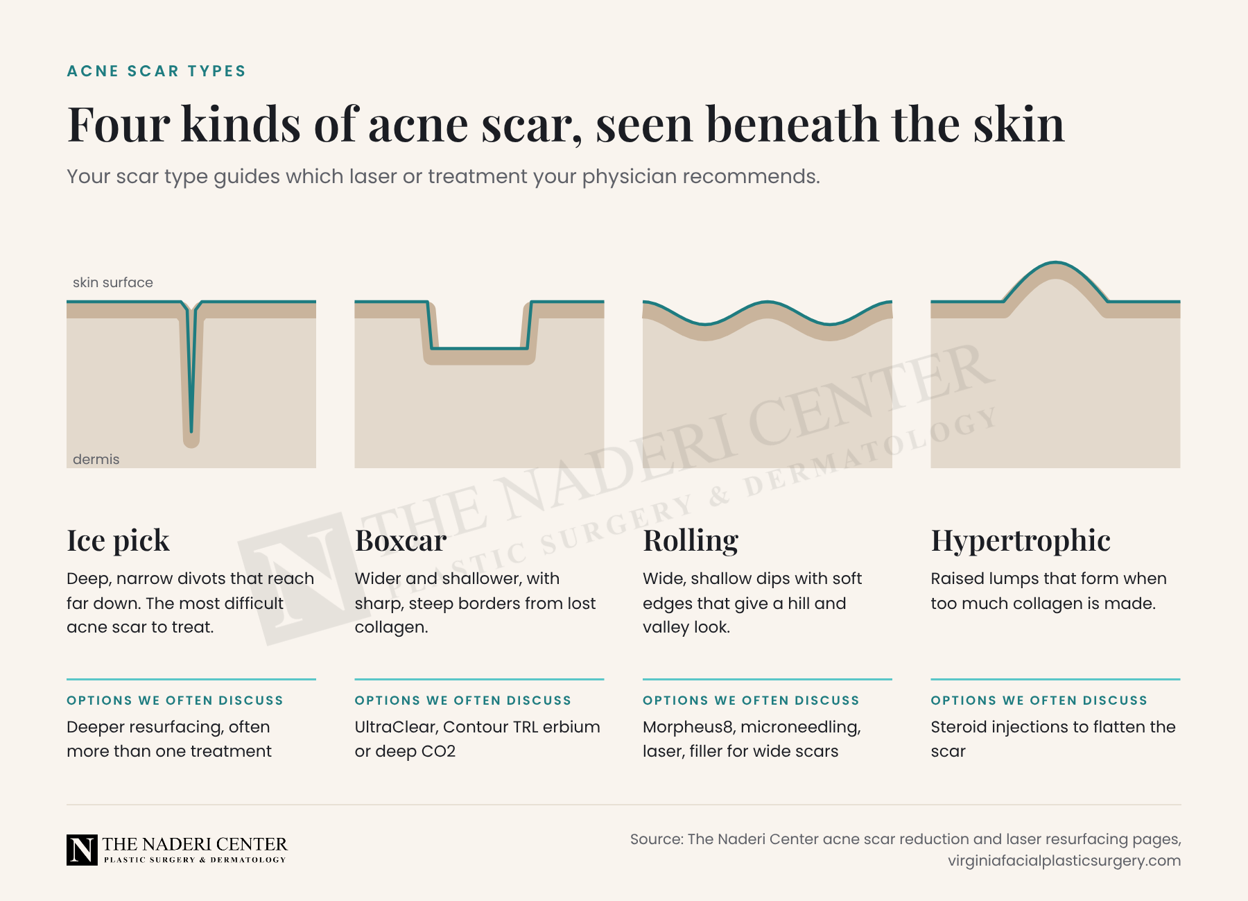 Diagram of four acne scar types beneath the skin: ice pick, boxcar, rolling and hypertrophic, with the treatment options The Naderi Center often discusses for each