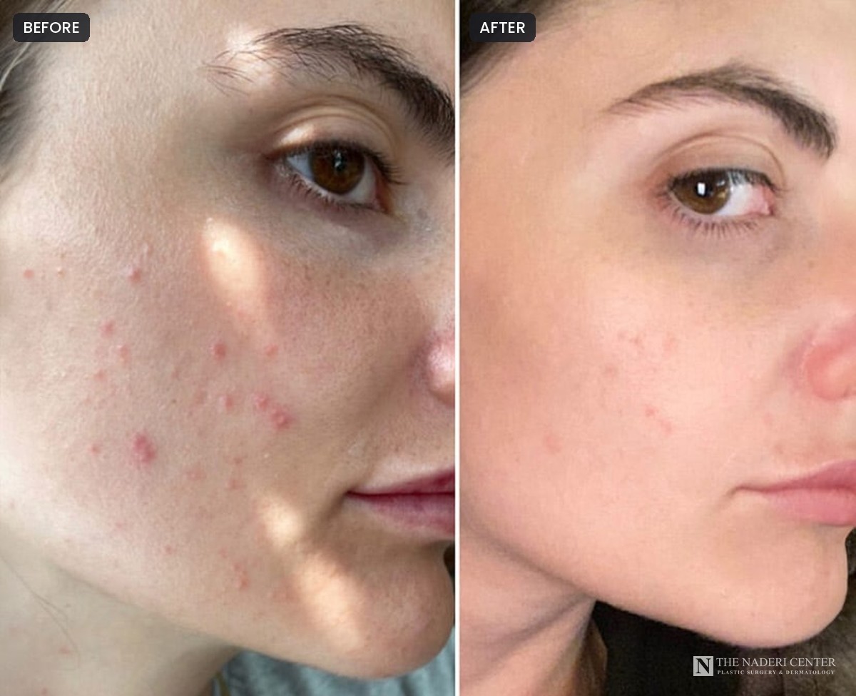 Before and after a combined, multi-treatment plan for active acne, side view, patient of The Naderi Center
