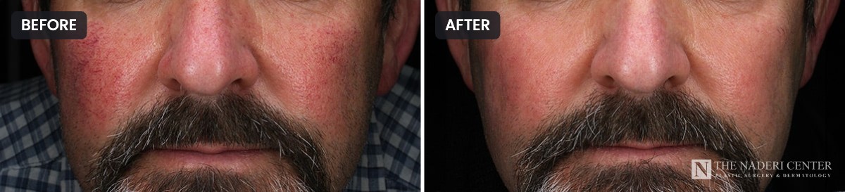 Man's cheeks and nose before and after a series of four BBL treatments for facial redness