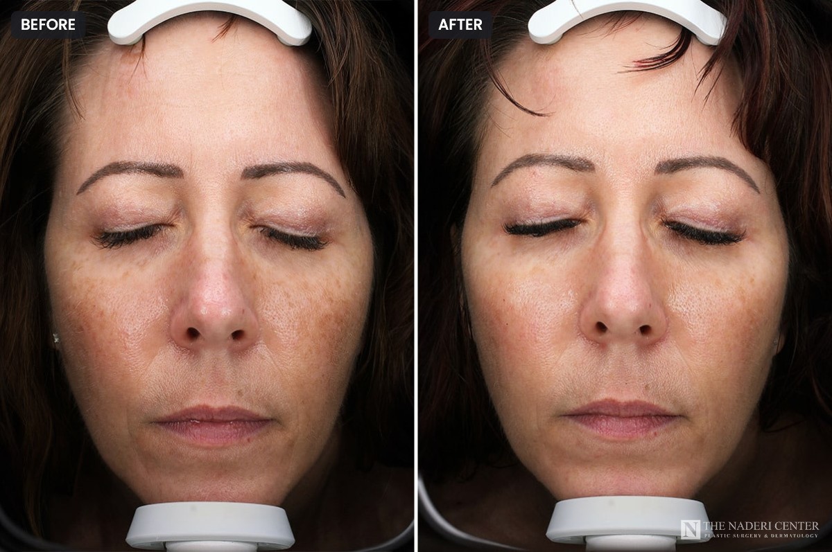 Before and after a series of BBL photofacial treatments for brown and red pigmentation