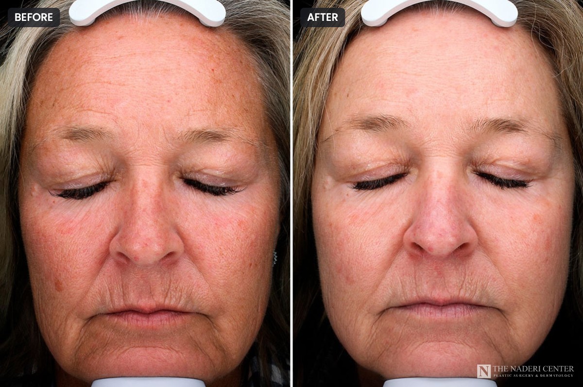 Before and after one BBL treatment for red and brown facial pigmentation