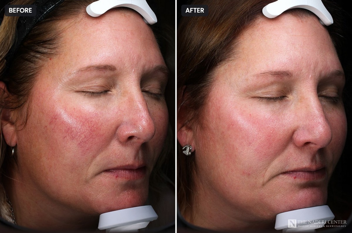 Before and after three Sciton BBL sessions, showing calmer cheek redness