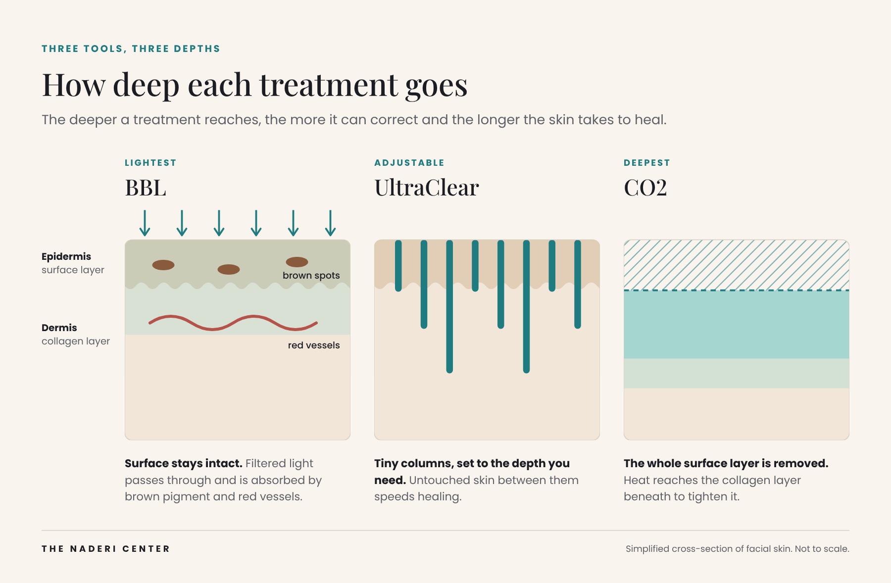 Diagram comparing how deep BBL, UltraClear and CO2 laser treatments reach into the skin