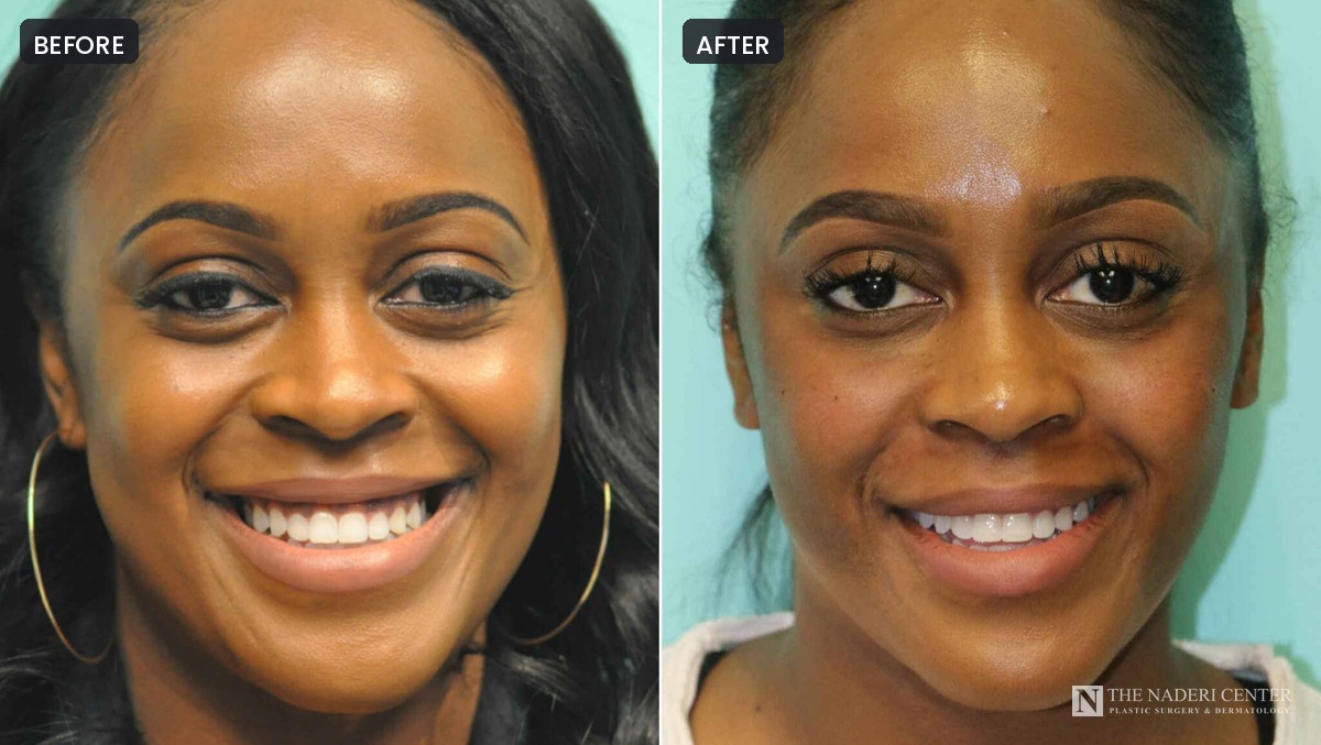 Before and after Botox for a gummy smile, patient 12680, The Naderi Center