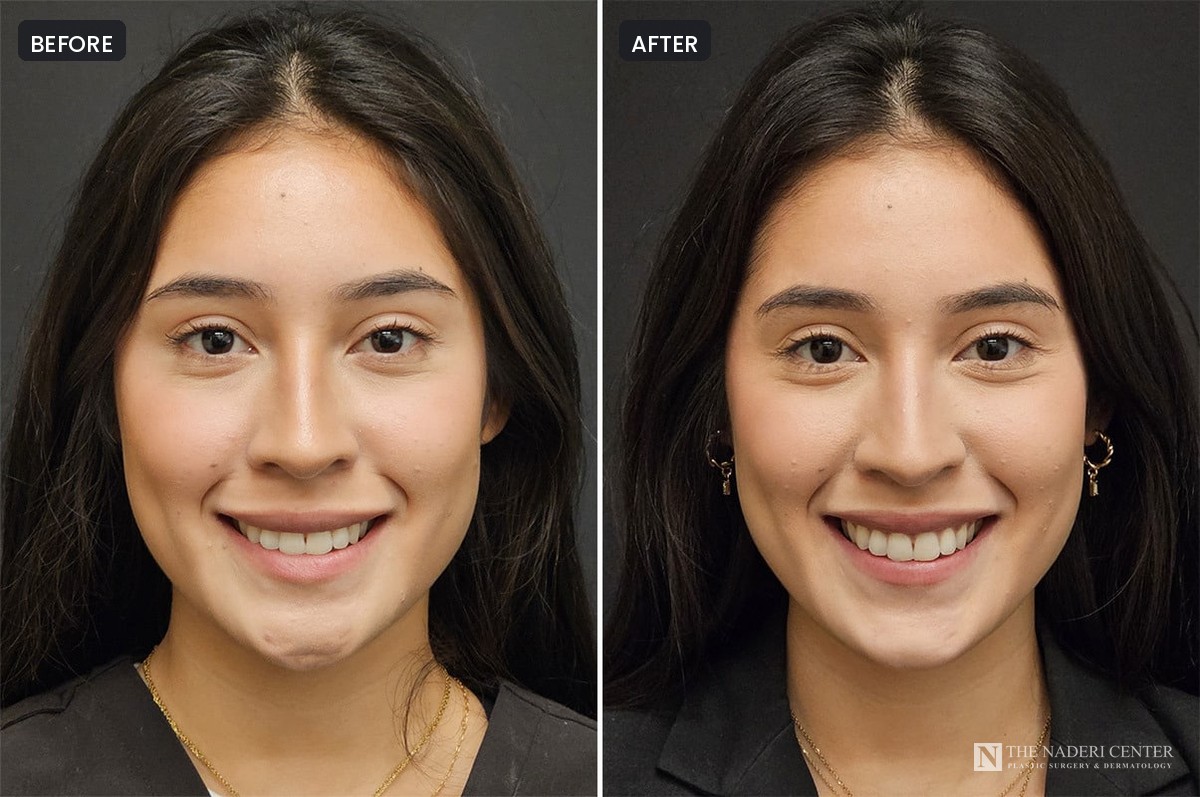 Before and after Botox for chin dimpling, patient 36976, The Naderi Center