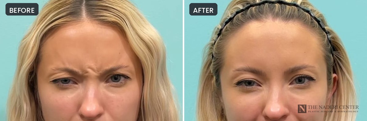Before and after Dysport for frown lines, patient 36984, The Naderi Center