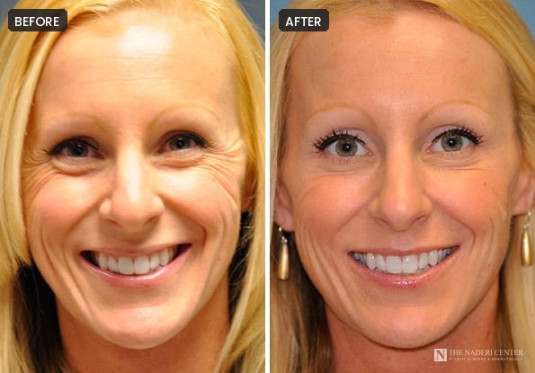 Before and after Botox for crow's feet, patient 8963, The Naderi Center