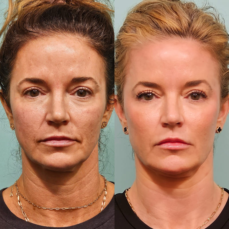 Botox Before And After