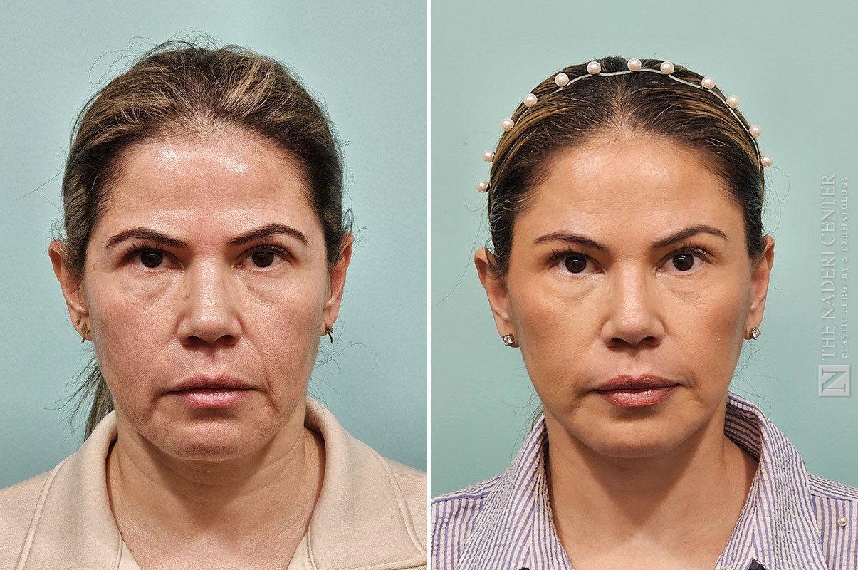 Before and after brow lift at The Naderi Center, Reston, VA and Chevy Chase, MD, front view, two months after surgery
