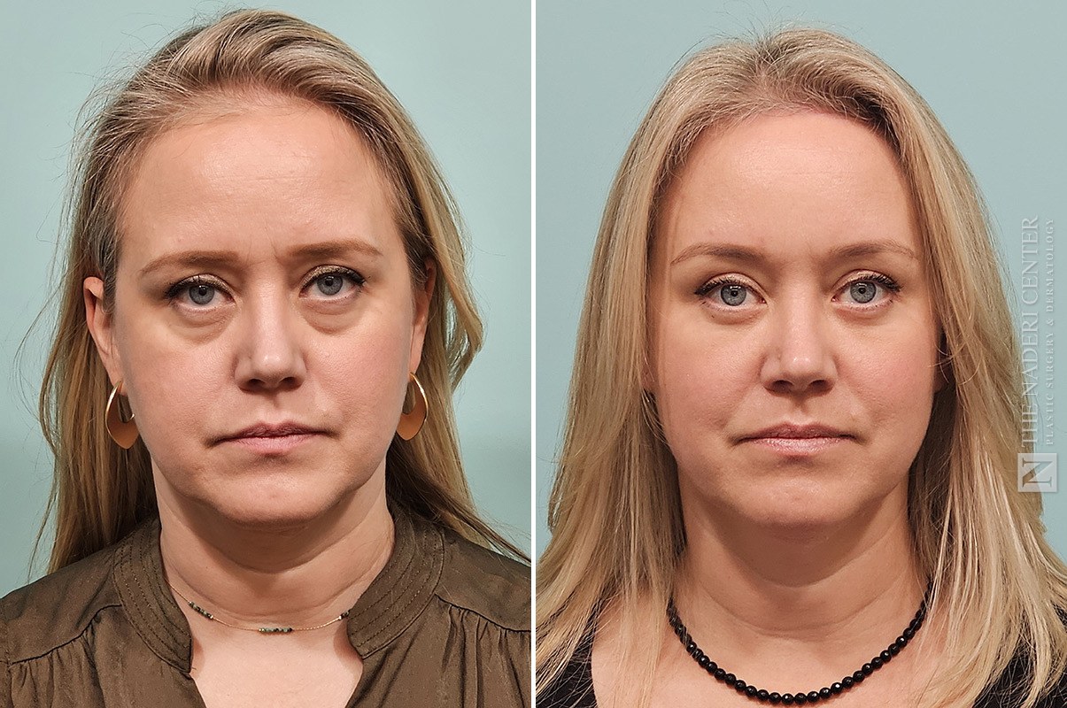 Before and after brow lift at The Naderi Center, Reston, VA and Chevy Chase, MD, front view, four months after surgery