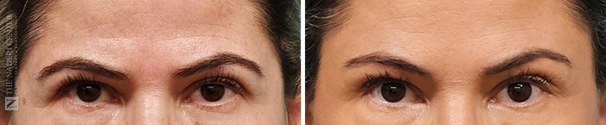 Before and after brow lift at The Naderi Center, close-up of the brows and eyes, two months after surgery