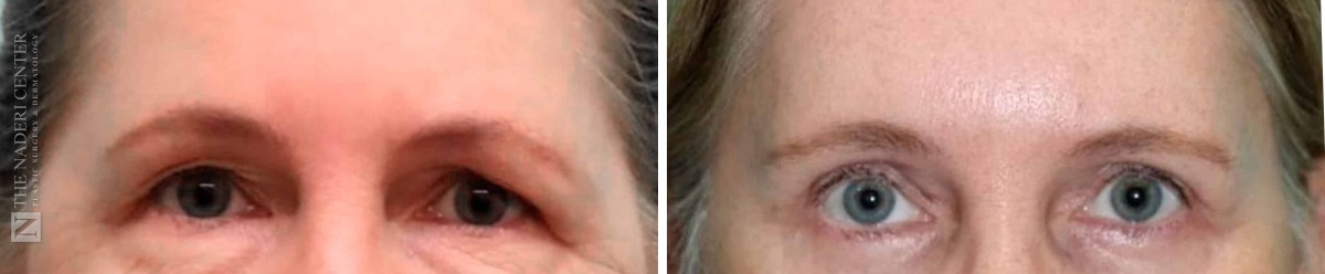 Before and after brow lift with upper and lower eyelid surgery at The Naderi Center, close-up of the brows and eyes