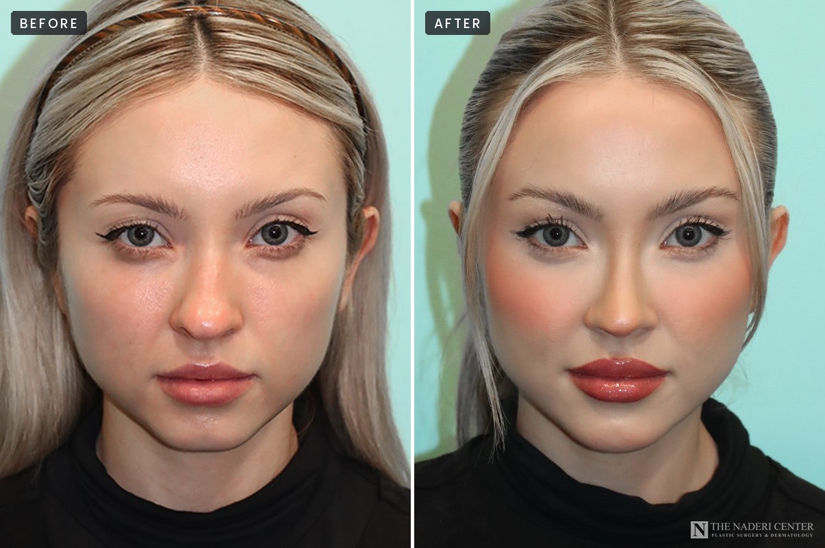 Before and after dermal filler injections, front view, The Naderi Center