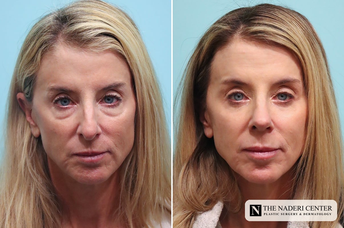 Before and after full-face CO2 laser resurfacing with lower eyelid surgery at The Naderi Center