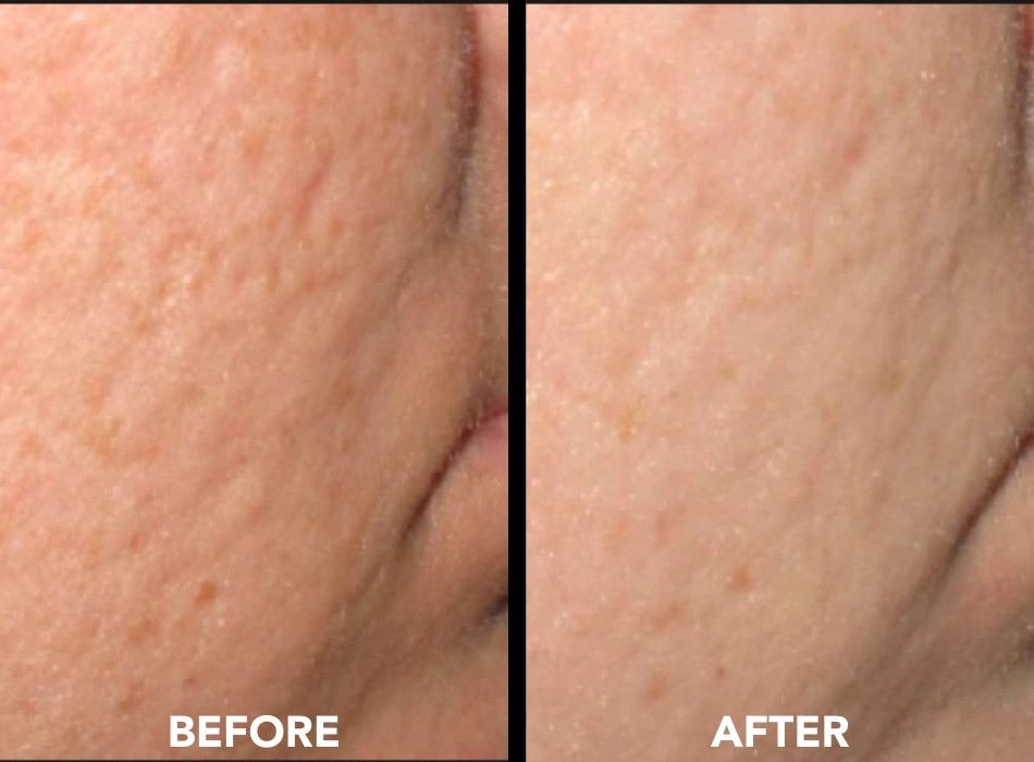 Acne scars before and after Collagen P.I.N. microneedling, photo courtesy of Induction Therapies