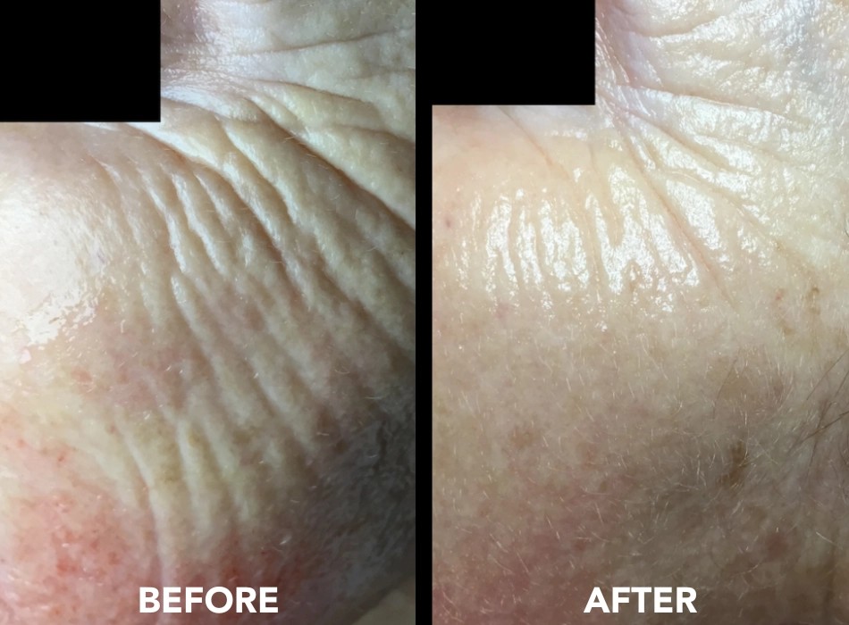 Crepey skin texture before and after Collagen P.I.N. microneedling, photo courtesy of Induction Therapies