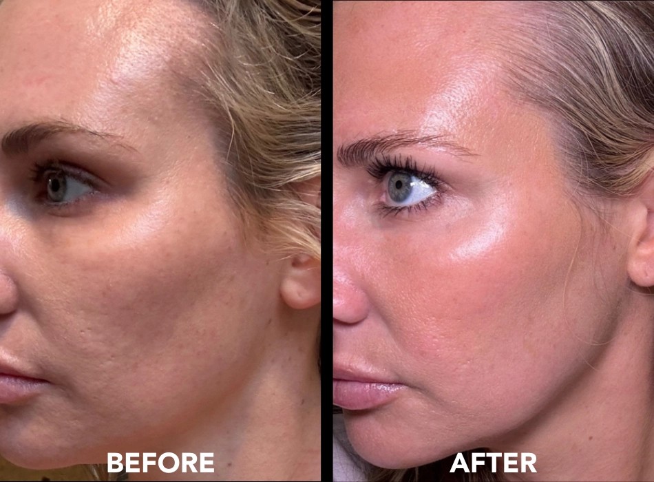 Skin tone and glow before and after Collagen P.I.N. microneedling, photo courtesy of Induction Therapies