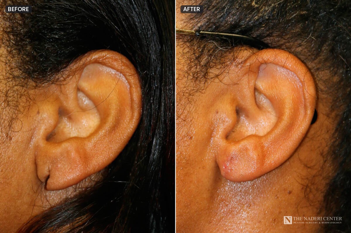 Before and after torn earlobe repair, side view of the left ear