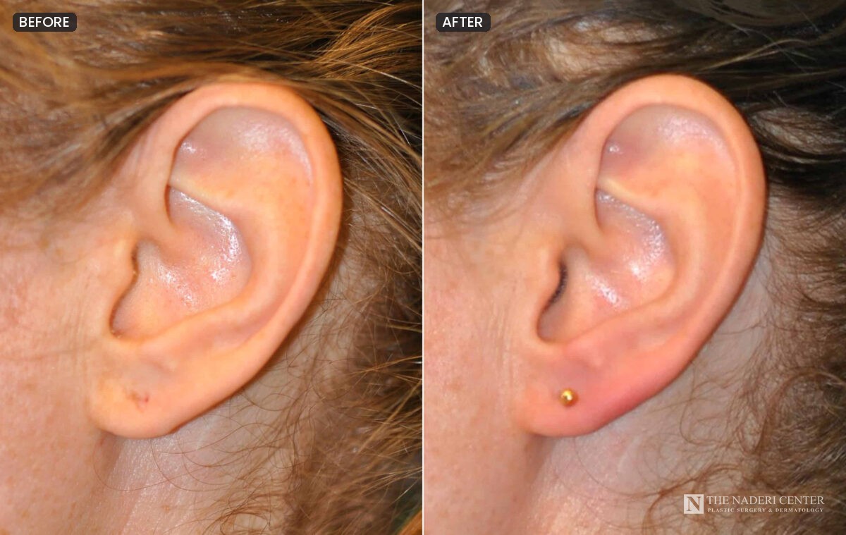 Before and after stretched earlobe repair with the ear re-pierced and a small stud earring