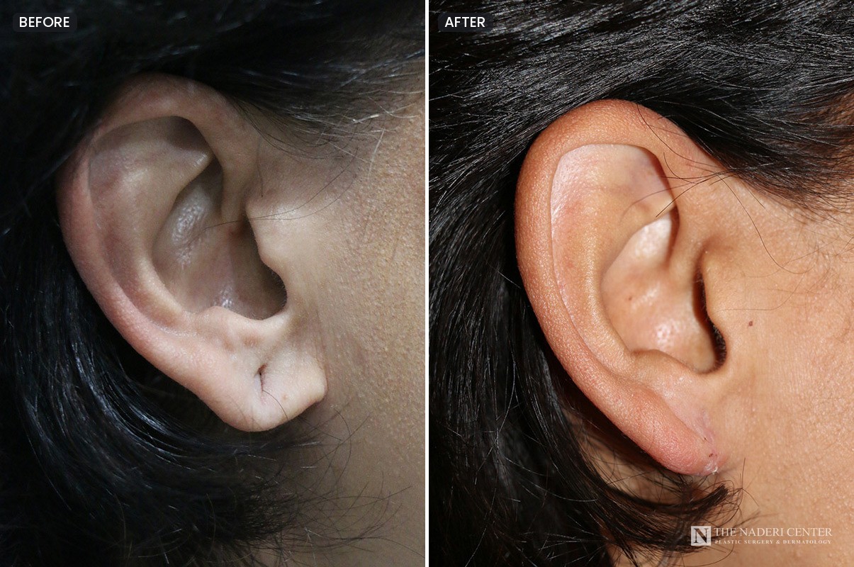 Before and after repair of an enlarged earlobe piercing hole from heavy earrings, side view