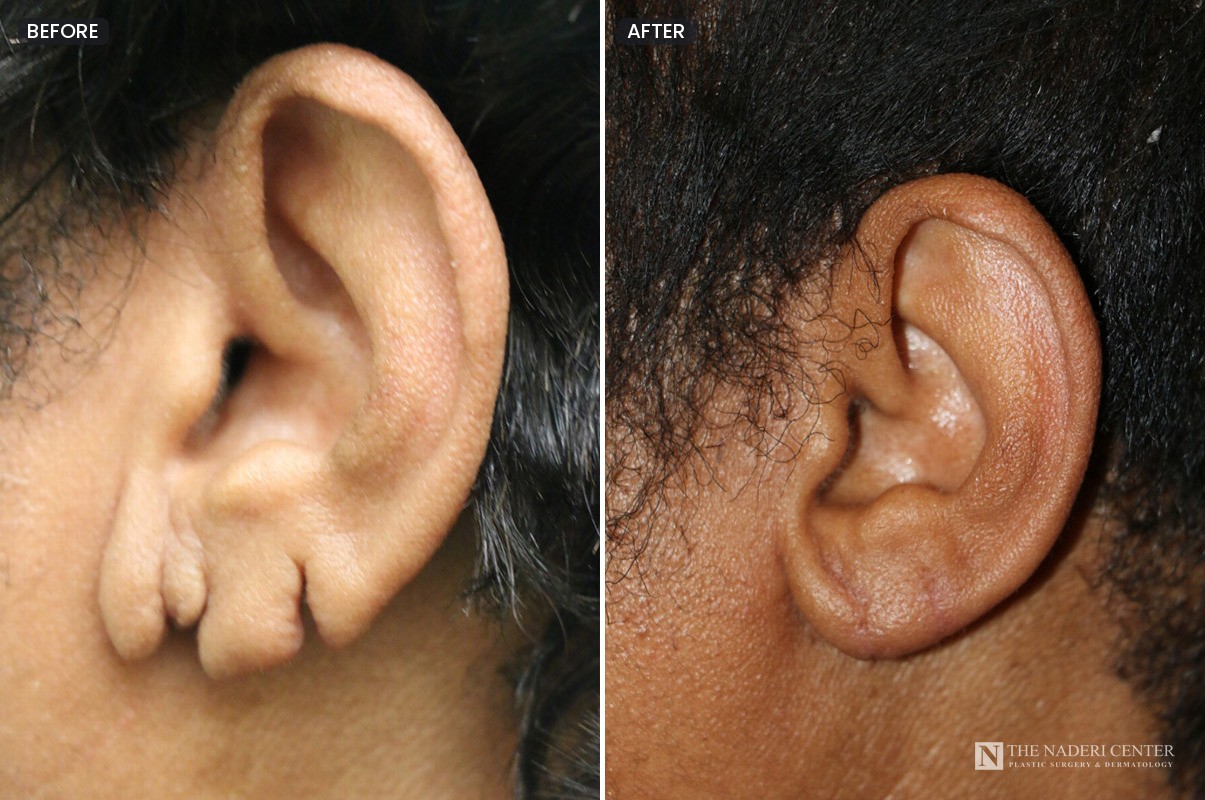 Before and after repair of two old tears in the earlobe, side view