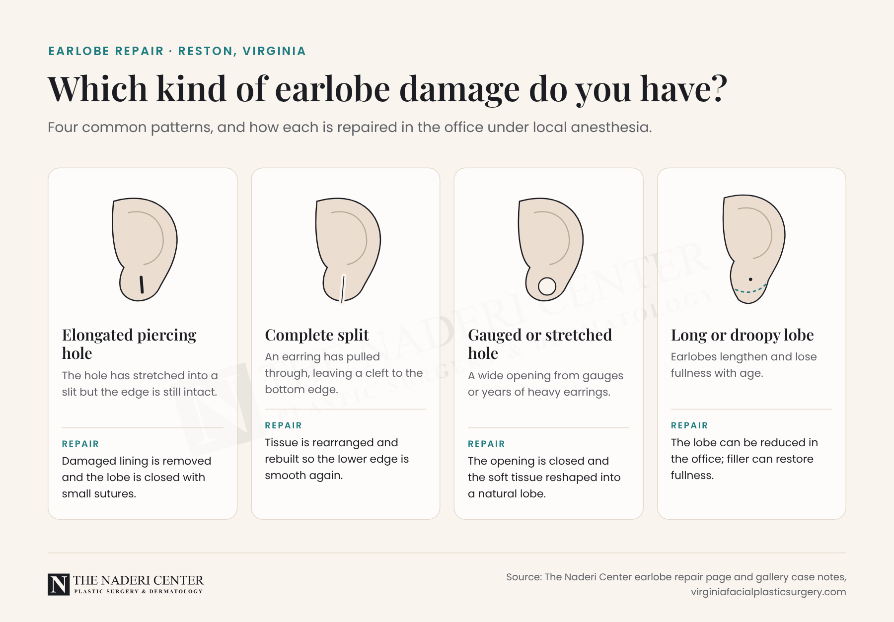 Diagram of four types of earlobe damage: elongated piercing hole, complete split, gauged or stretched hole, and long earlobe, with how each is repaired