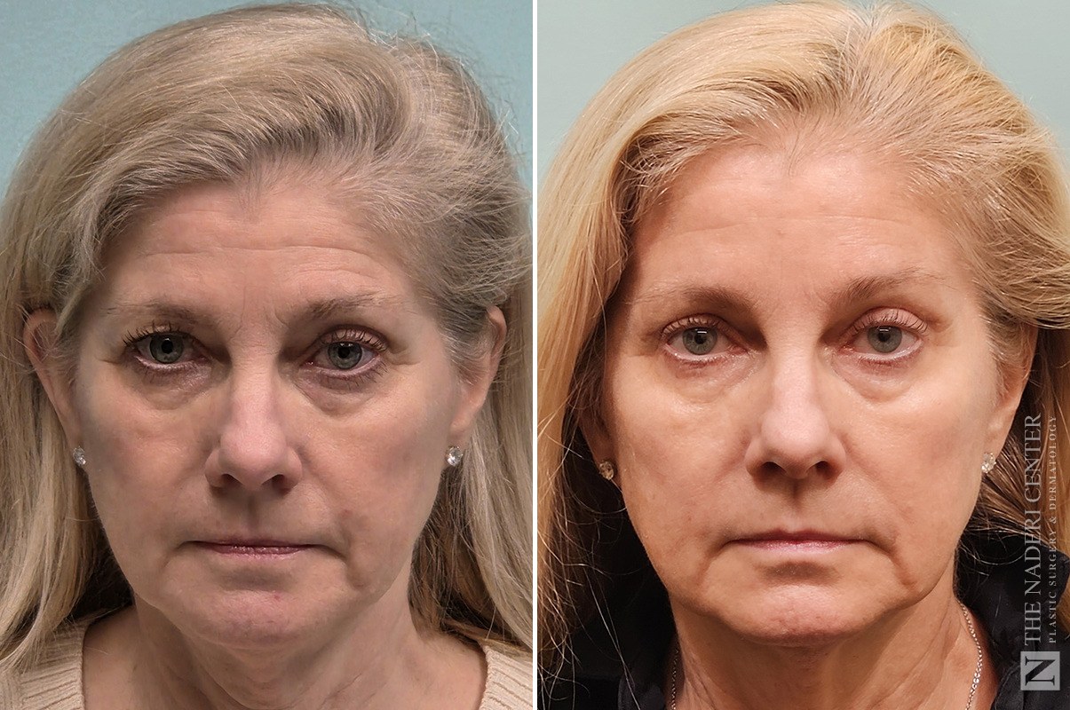 Before and after endo-style brow lift and upper eyelid surgery at The Naderi Center, Reston, VA and Chevy Chase, MD