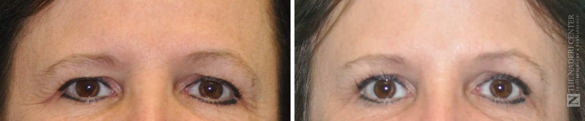 Before and after endoscopic brow lift at The Naderi Center, close-up of the brows and eyes