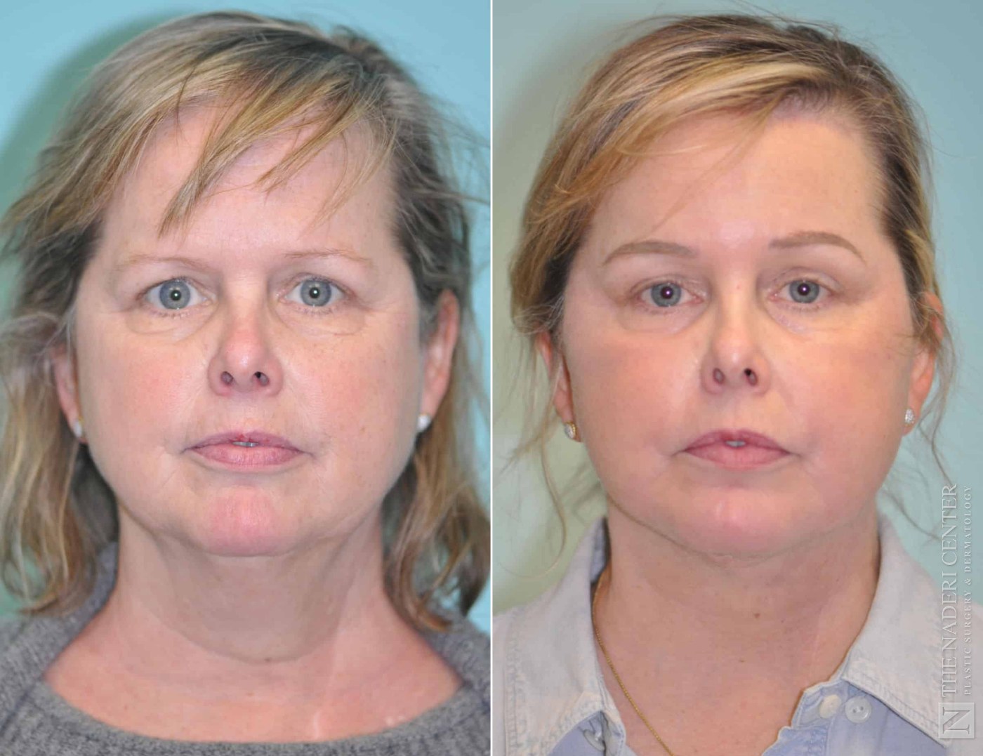 Before and after endoscopic brow lift with Endotines, facelift and CO2 laser resurfacing at The Naderi Center, front view