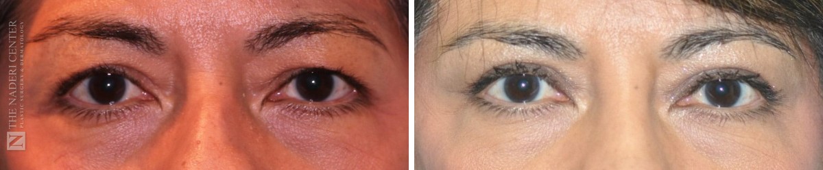 Before and after endoscopic brow lift with upper eyelid surgery for uneven brows at The Naderi Center, close-up of the brows and eyes