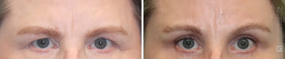 Before and after endoscopic brow lift with upper and lower eyelid surgery at The Naderi Center, close-up of the brows and eyes