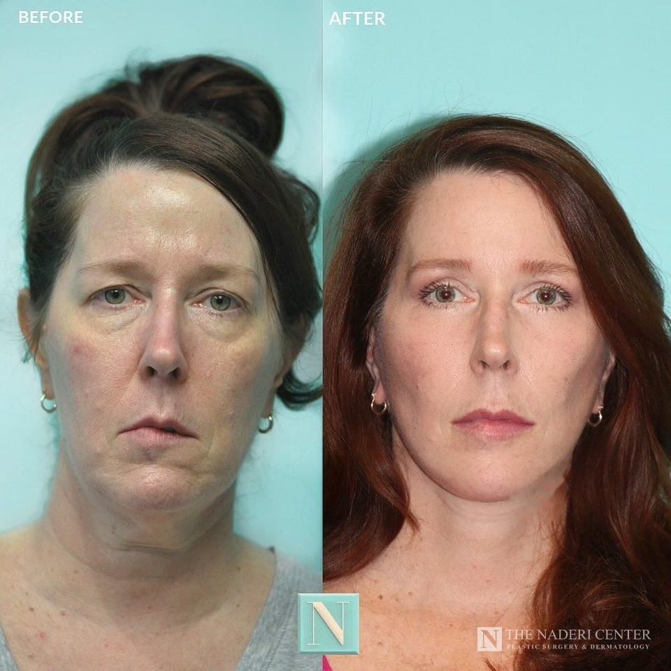 Facelift, neck lift, eyelid surgery and CO2 laser before and after, real patient at The Naderi Center in Reston, VA and Chevy Chase, MD