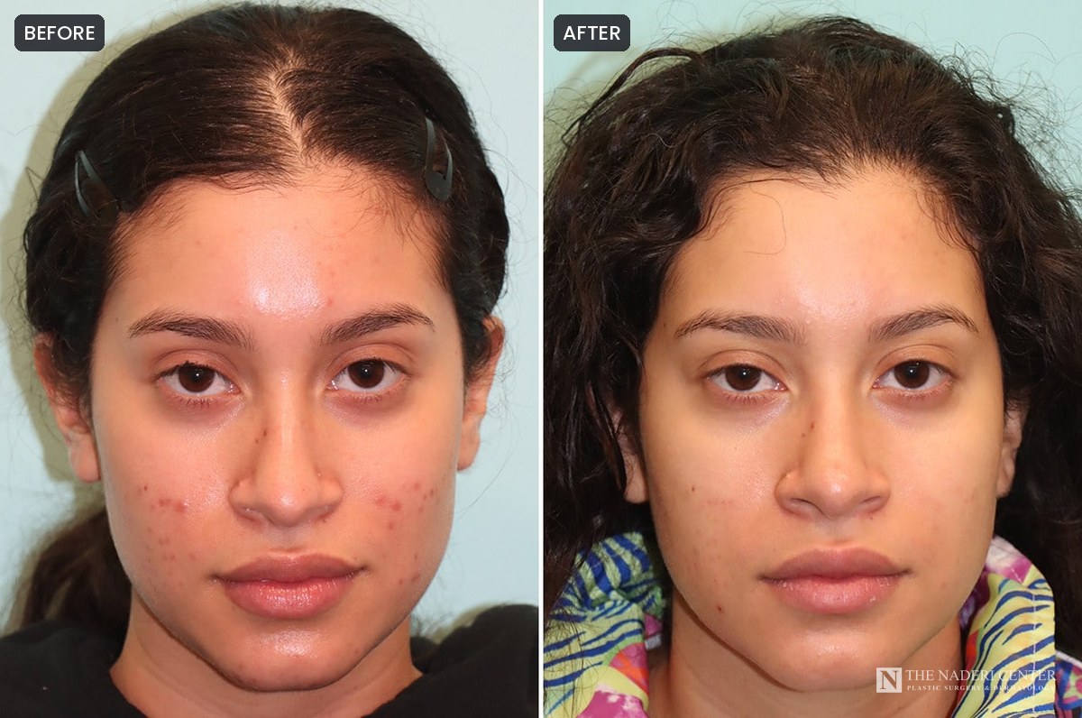 Before and after routine BBL treatments, facials and a medical-grade skincare program, showing calmer, clearer skin, at The Naderi Center