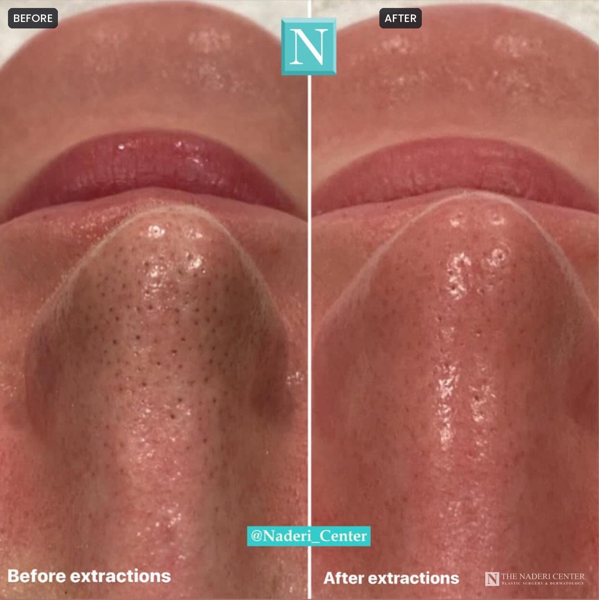 Close-up before and after a custom facial with extractions, showing clearer pores on the nose, at The Naderi Center