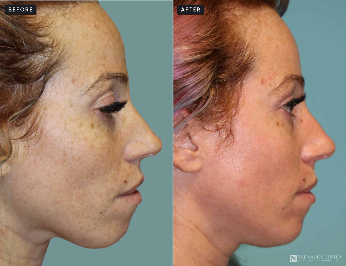 Before and after one BBL treatment and a nanolaser peel for freckles, The Naderi Center