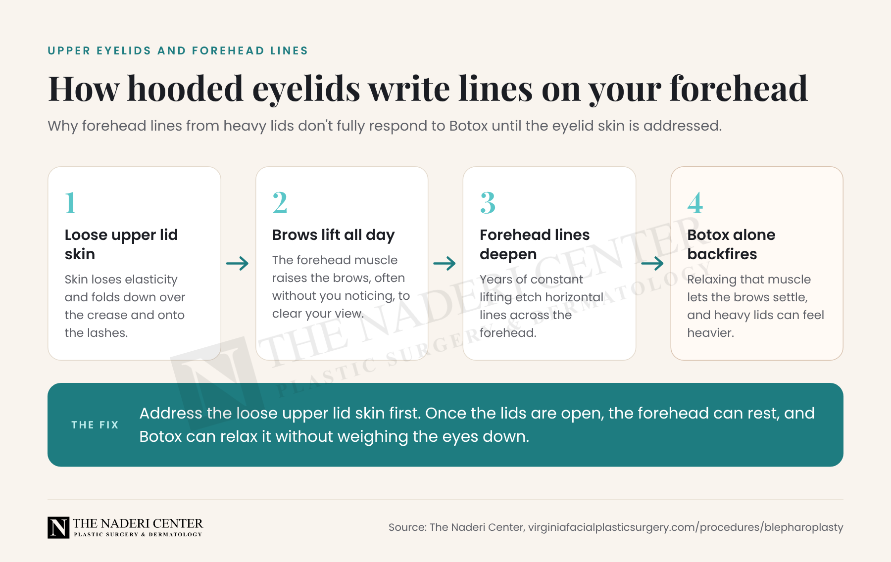 Diagram of how hooded upper eyelids lead to forehead lines, and why Botox alone can make heavy eyelids feel heavier