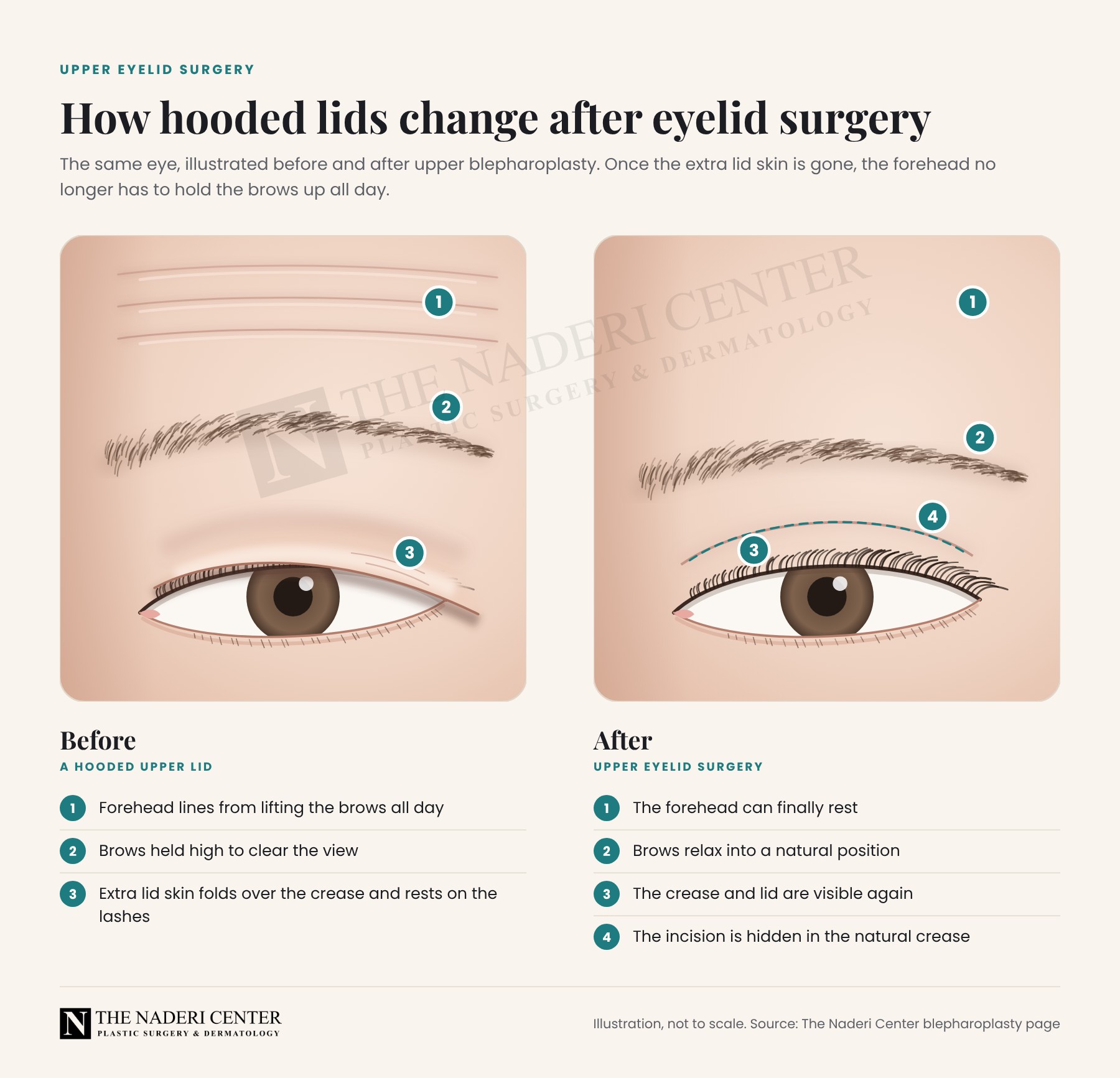 Illustration of a hooded upper eyelid with forehead lines and raised brows, and the same eye after upper eyelid surgery with a visible crease and the incision hidden in the natural crease