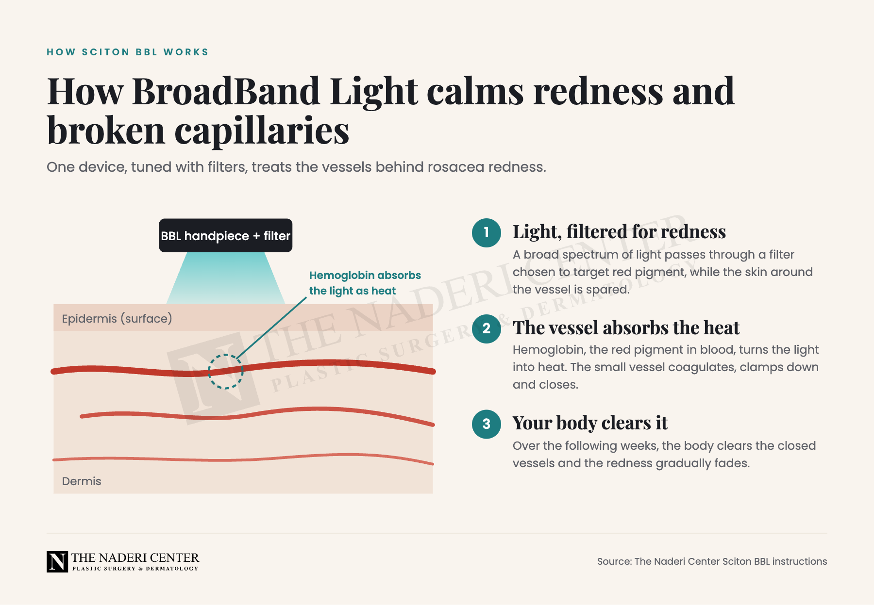 Diagram of how Sciton BBL light is absorbed by hemoglobin in small facial vessels to calm rosacea redness